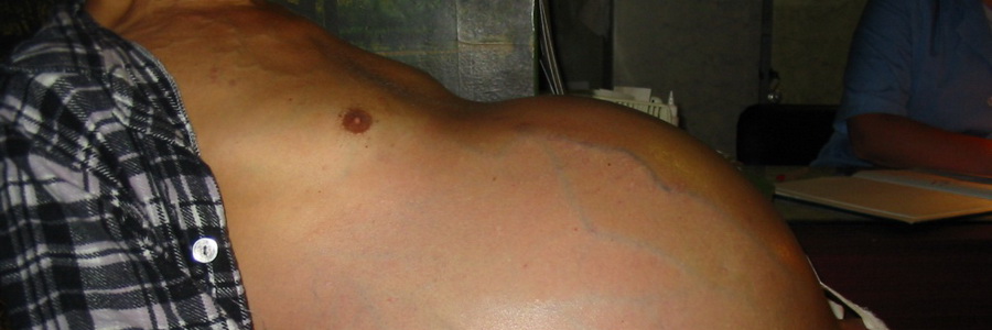 Увеличение печени