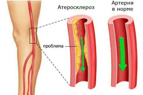 Препараты для лечения атеросклероза