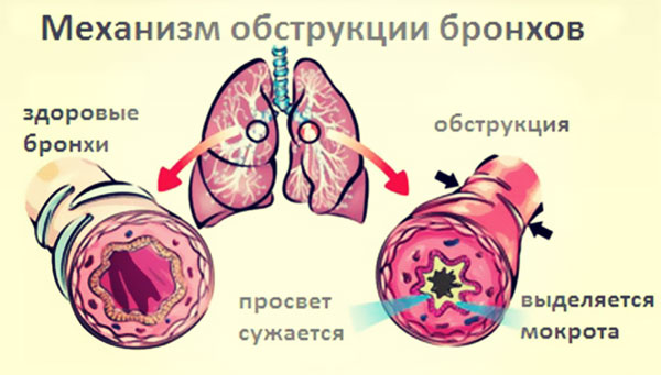 Обструктивный бронхит