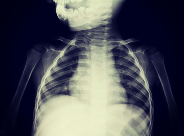 Обструктивный бронхит