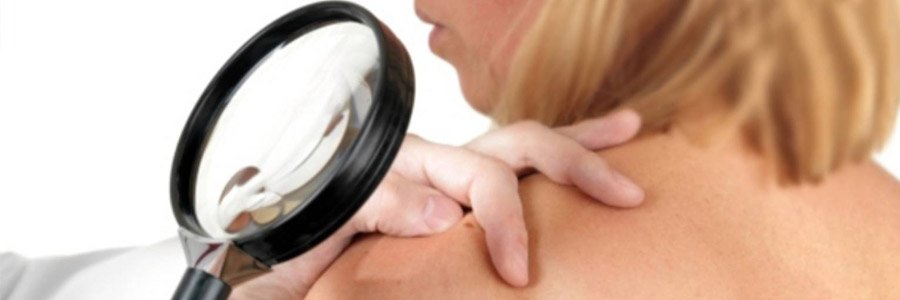 Экзема - причины, симптомы, лечение