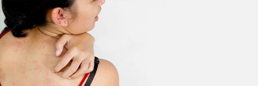 Крапивница - причины, симптомы, лечение