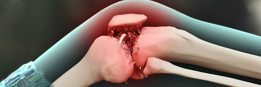 Лікування остеоартрозу та метаболічного синдрому