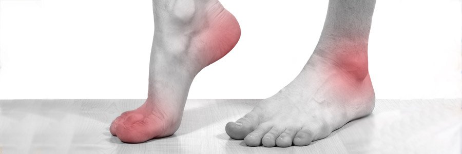 Подагра - причины, симптомы, лечение