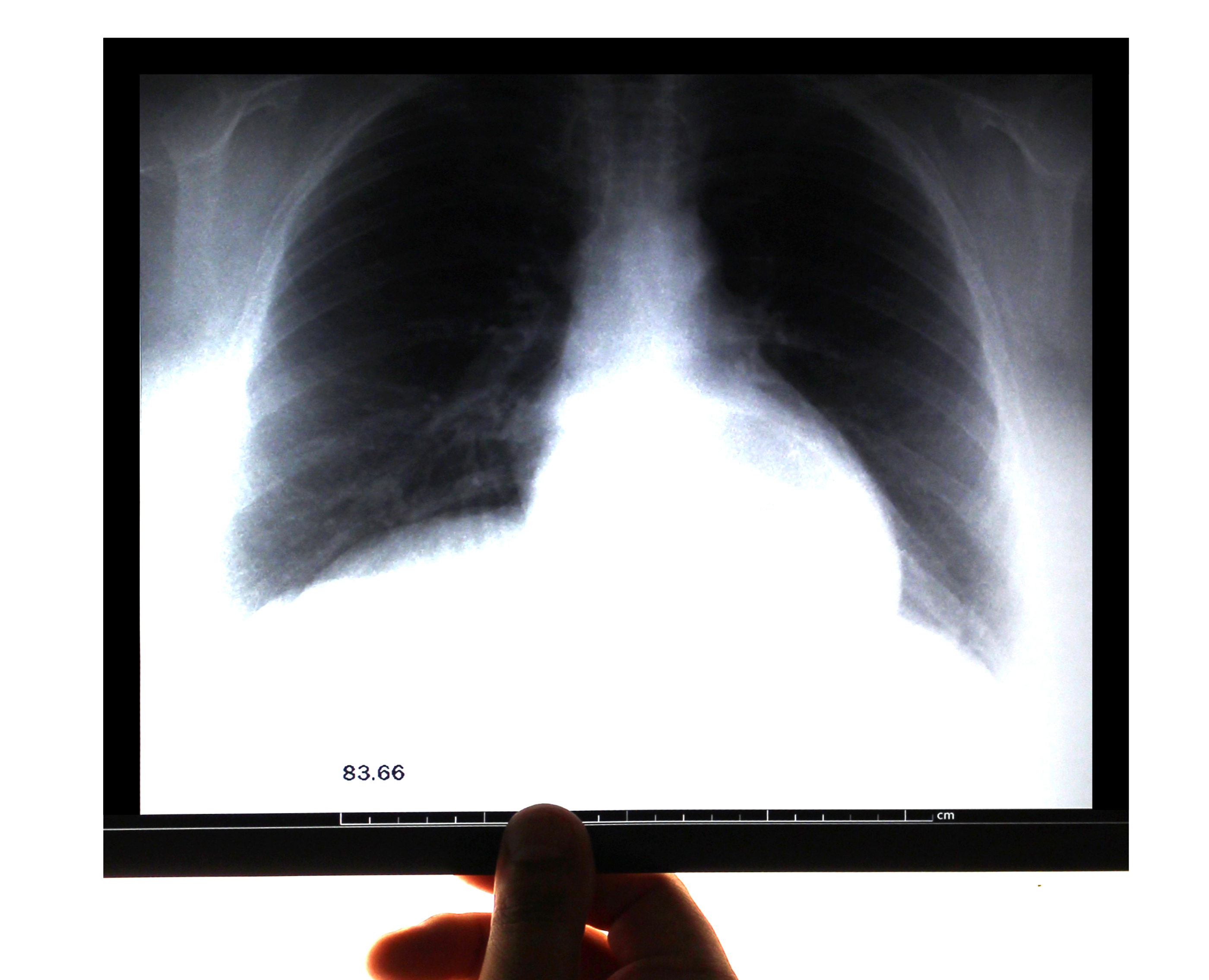 обструктивный бронхит