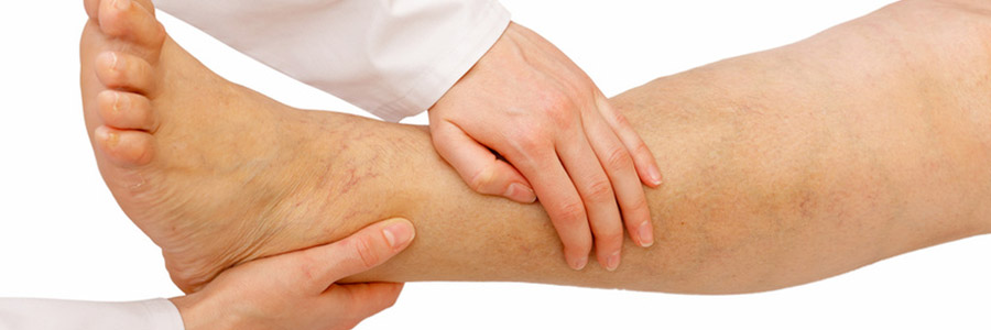 Тромбофлебіт - причини, симптоми, лікування