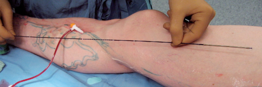 Флебит – причины, симптомы и лечение